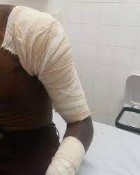 Briga entre casal termina com queimaduras graves e ferimentos em Ji-Paraná